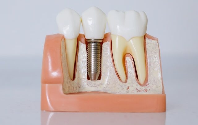 Czy implanty zębowe są zalecane wśród osób z cukrzycą?
