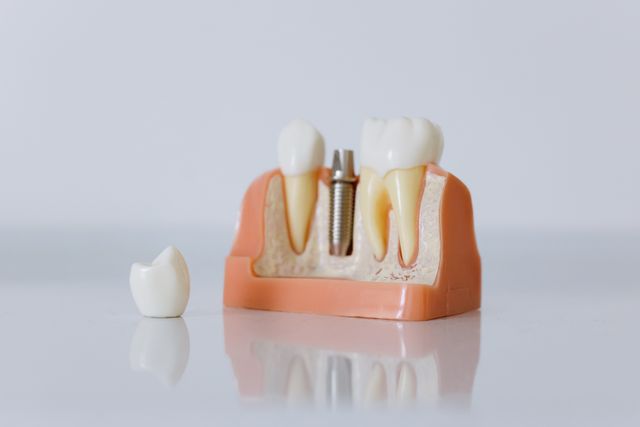 Jaką funkcję pełni śruba gojąca w implantacji zęba?